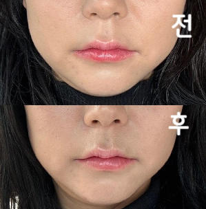 1회차 맞고 2회차 맞았어요 이번엔 스테로이드 있는 거로 맞았고 인모드 작은얼굴 패키지도 같이 맞았어요~