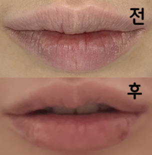 입술필러 맞으면서 입꼬리 보톡스 같이 했어요! 덕분에 입술필러 효과가 더 길어지길 바라요~