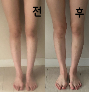 지방 많은 부분 찾아서 주사 잘 놓아주세요! 다이어트 하면서 맞으면 유지되면서 원하는 부위 이쁘게 잘 빠져요~