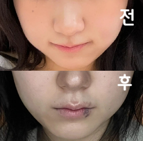 붓기 다 빠지고 확실히 슬림해진 느낌!!