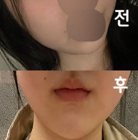 2회차 맞았습니다 ㅎ 이번에는 남자원장님이 놔주셨는데 멍도 하나도 안 들고 붓기도 더 빨리 빠진 느낌? 3회차까지 맞아보려구요~