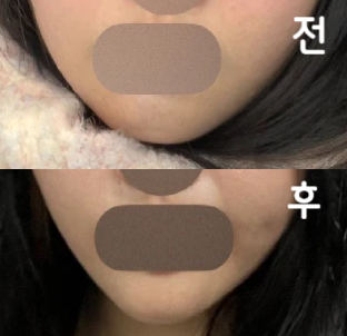 자갈턱 보톡스 맞았는데 턱필러 하면서 같이 진행했고 아래 턱 튀어나온 게 고민이었는데 많이 좋아졌습니다!!