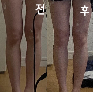 모니터에 당첨되어 찾아왔습니다. 접수처나 간호사분들 모두 너무 친절하셨어요~