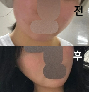 얼굴 살이 안 빠져서 맞았는데 진짜 효과 너무 좋고 시간도 빠르구 또 맞을겁니다 헤헤~