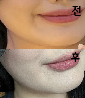 전에 한 번 맞고 효과가 너무 좋았어서 한 번 더 방문했습니다!