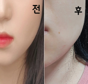 시술 해주시는 선생님은 친절하시고 상담해주시는 분도 다 너무 좋았어요..