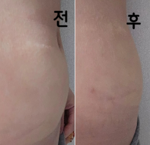 상당히 좋았고 아직은 붓기가 있는 상태라 잘 모르겠지만 주사 놓으실 때 확인 열심히 해주시고 상담 및 치료 과정이 상세하고 좋았어요!!!