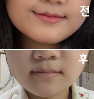 1차라서 엄청나게 효과가 있는 건 아니지만 그래도 얼굴 살 정리된게 보여서 너무 만족이에요~ 2-3회차도 맞으려구요 추천드려요오!