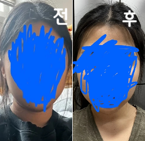 드라마틱한 효과는 없는데 라인정리는 되는 듯