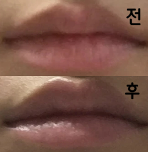 일단 가격면에서 너무 가성비 있다고 생각했는데 시술까지 받고나니 너무 대만족이네요 ㅠㅠ