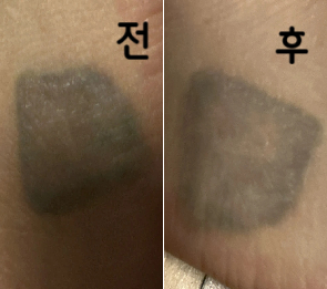 제거 잘 했어요! 안내해주신 간호사분 너무 친절하셨고 의사 분도 친절하셨어요~