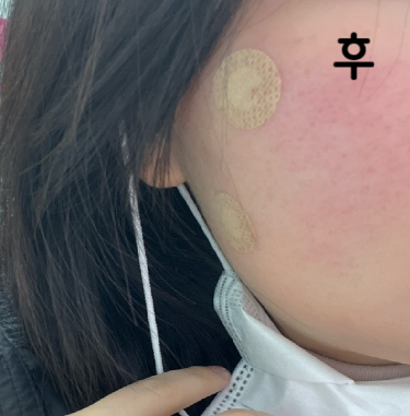 생각보다 통증은 없었지만 그래두 약물 들어갈 땐 뻐근합니다~~ 효과 좋으면 또 받을 예정!