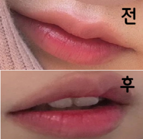 입이 원래 옹졸했고 인중이 길어서 좀 짧아지고 싶었어용~