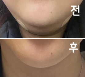 지난번에 맞고 효과 좋아서 한 번 더 방문했습니다!