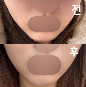 처음 받는 시술인데 아프지도 않았고 효과가 기대돼요~