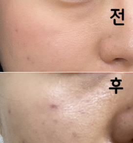 주사자국은 좀 남았는데 완벽하게 녹은 거 같아요!!