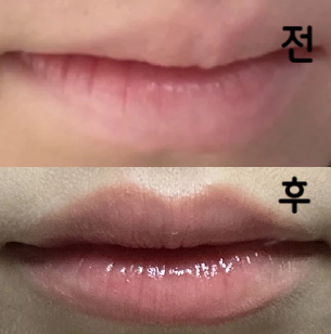 다른 곳보다 가격이 저렴해서 선택했어요 비대칭이 조금 보이는게 아쉽긴 하지만 자연스럽게 넣어주셔서 만족해요~