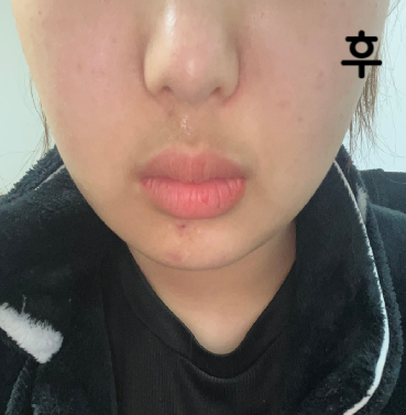 대기시간이 생각보다 있지만 기다릴만하고 다른 곳보다 윤곽주사가 덜 아파서 3번 맞을 수 있을 것 같아요~