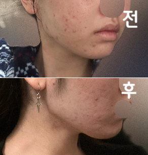 이곳에서 시술을 부탁한 이유는 뭐니뭐니 해도 매우 쌌던 것과 일본 마케팅을 잘 하고 일본인도 많았기 때문입니다!