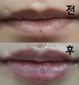 입술필러하면 롤리팝이라는 이미지가 있고, 입소문도 좋아서 예약했습니다 만족합니다!