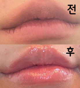 대기가 좀 있었지만 원장님이 원하는 만큼 필러를 잘 놔주셨어요! 넘 만족합니다 다음에 또 방문할게요~