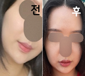 붓기 많이 빠졌고 효과 있는 것 같아요!