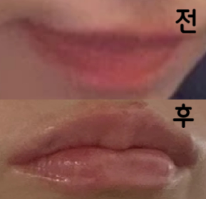 일본에 비해 파격적인 가격에 시술 가능하며 마무리도 대만족입니다!! 또 한국 가면 부탁하고 싶어요!!