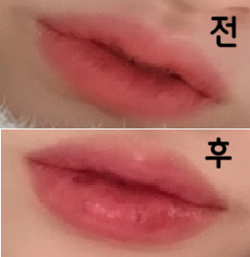 엄청 친절하고 하나하나 알려주셨어여! 비용도 합리적이었고 통증은 없고 붓기도 딱히 없었어요!!