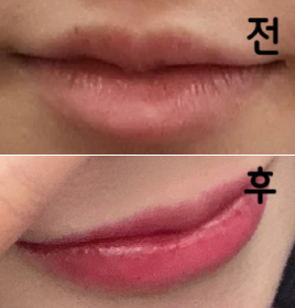 붓기가 빠지고 자연스러워졌다 멍은 조금 있지만 컨실러로 지워지는 정도!