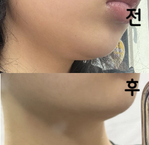 주사 하나도 안 아프고 멍은 안 빠졌는데 효과는 있습니다!