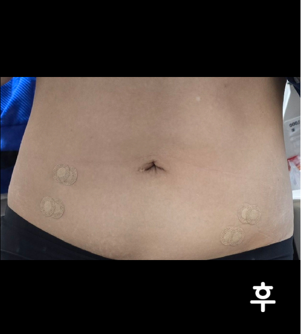 애 낳고 복부가 그렇게 안 빠지더라구요;; 효과 조금이라도 보게되면 그 때 가서 추가로 받으려구요~!