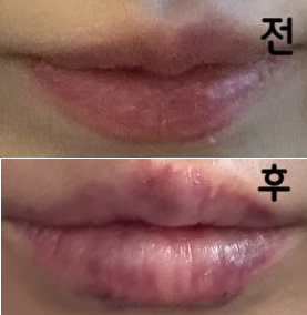 상담 실장님도 너무 친절하셨고, 시술 할 때는 원장님께서 입술 모양 잡아주시면서 섬세하게 하나하나 해 주시는게 너무 좋았습니다!