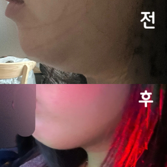 확실히 1차라 큰 변화는 없는 것 같은데 다이어트랑 병행 중이어서 턱 쪽 살은 정리 되는 느낌이에요! 2차 3차도 맞을 예정입니당~