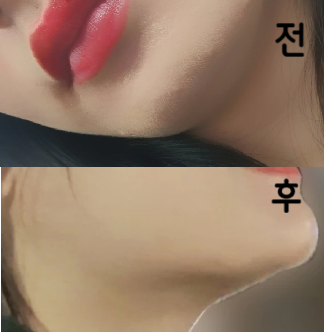 3-5번은 해야 효과 좋다는 얘기 듣고 2번째 시술했습니다! 첫번째에도 확실히 줄었다고 느껴서 꾸준히 하면 이중턱 사라지지 않을까 기대하고 있어요~