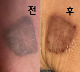 처음에는 부음 증상이 있고 따가웠는데 3주 넘어서 확실히 아프거나 붓기 증상이 하나도 없어져서 달리기나 운동도 편히 해요!