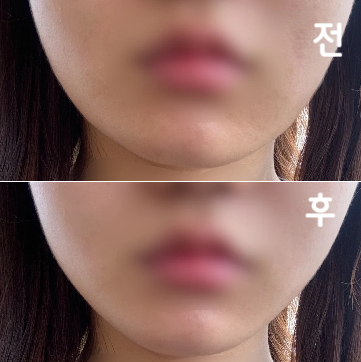 이틀 차부터 얼굴이 전반적으로 더 날렵해 보였고, 즉각적인 효과를 느꼈어요!