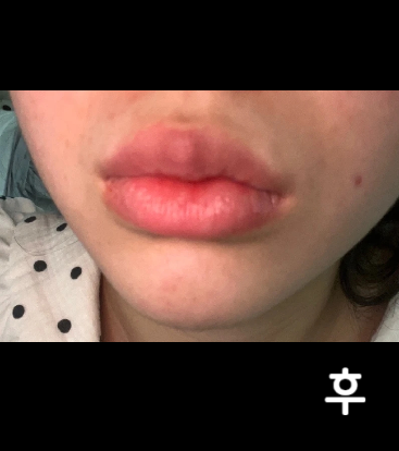 평소에 얼굴 살이 많아서 고민이였고 한 번 맞았을 때 효과 있었어서 다시 예약해서 오랜만에 맞았는데 또 효과 봤던 것 같아요~