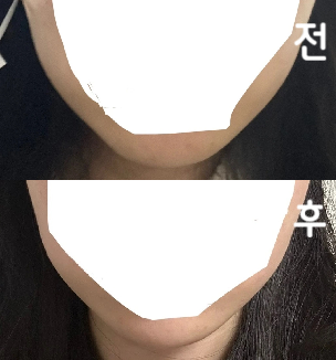 시술할 때 통증이 없었고 바로 일상생활을 할 수 있었어요~