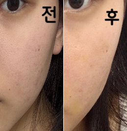 1회 받았을 때부터 효과 봐서 꾸준히 맞을 생각이에요~