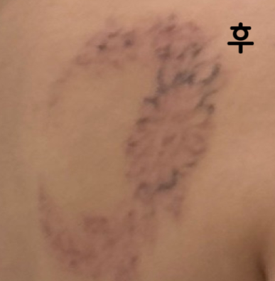 3번짼데 잘 지워지는 거 같아요~ 만족합니다 생각보다 많이 안 아파요~