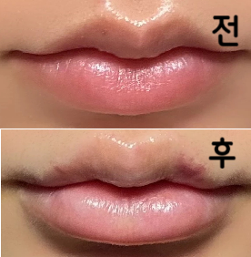 늘 입술필러는 다른 병원에서 맞다가 처음 와 봤는데 직원분들 전부 너무 친절하셨구 시술 해주신 의사 선생님께서도 하나 하나 신경 써 주시면서 진행해 주셔서 좋았습니다!
