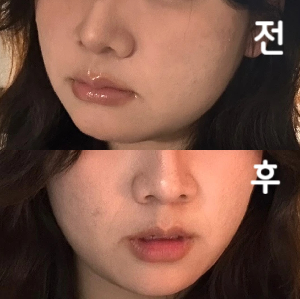 대기시간은 좀 긴데 3-2일 후부터 즉작적으로 효과가 있어서 2번째 맞습니다~