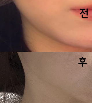 효과가 너무 좋아요! 턱 라인 만졌을 때 원래 지방이 말랑하게 만져졌는데 지금은 완전 턱 뼈만 만져져요!!