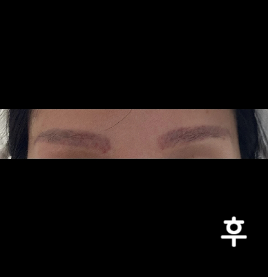 이미 10번 이상 큐스위치로 받았는데 아직 남아있어서 피코레이저로 받아봤어요~