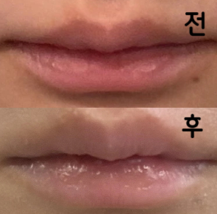 엘라보톡스와 입술필러 했어여~! 지난번에 입술 필러 여기서 했는데 좋았어서 또 했어요~