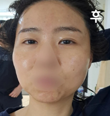 멍 흉터 거의 없네요 많이 아프지도 않았어요~