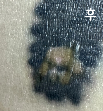 물집이 서서히 없어지면서 타투가 옅어지고 있어요~