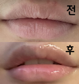 시술 직후에는 조금 오버했나 싶었는데 붓기 빠지고 나니까 확실히 너무 자연스러워져서 리터치때는 반영해서 더 넣으려구요!