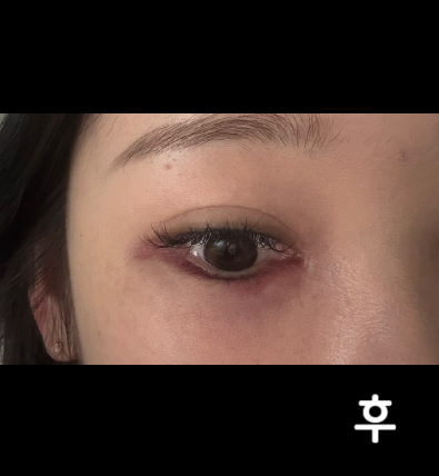여의사 선생님 꼼꼼히 잘 놔주셨어요~ 눈가라 멍은 들었답니다!
