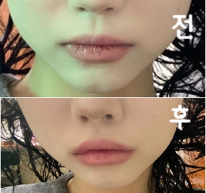 이런 시술 자체가 처음이라 진짜 무서웠는데 의사 선생님이 유쾌하게 긴장 풀어주셔서 감사했습니다!